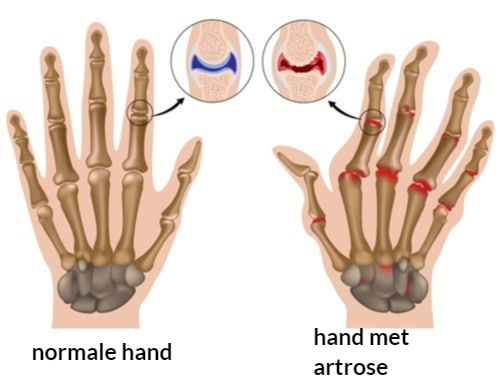 Artrose-Hand-Livit-Ottobock-Care
