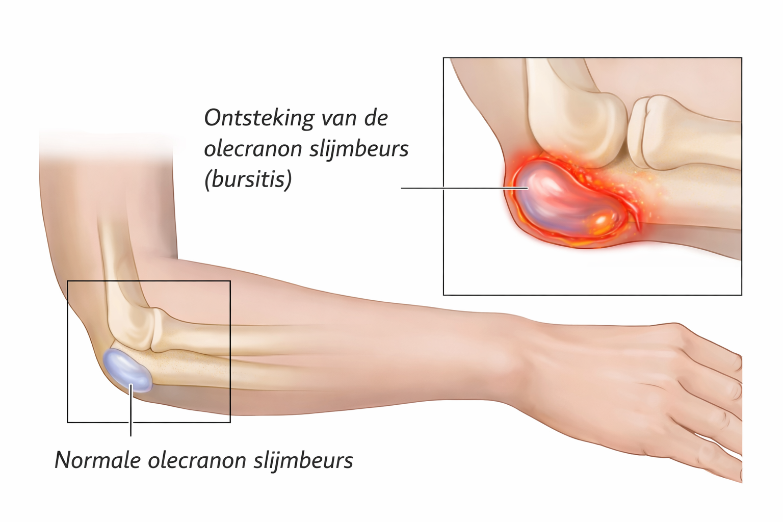 slijmbeurs-elleboog-1